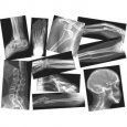 Roylco Broken Bones X-Rays with Teacher Guide - Set of 15